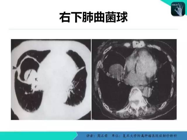 【PPT】肺癌的CT诊断