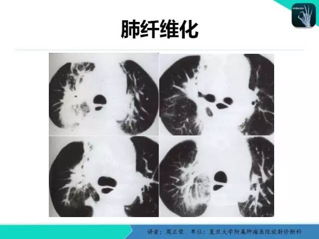 【PPT】肺癌的CT诊断