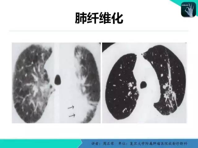 【PPT】肺癌的CT诊断
