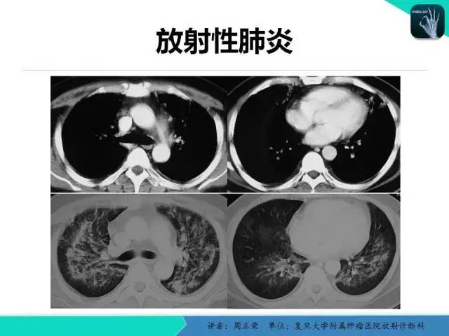 【PPT】肺癌的CT诊断