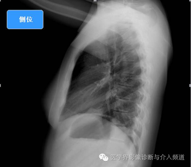 【病例】左肺下叶肺栓塞合并肺梗死1例CT影像表现 【病例】左肺下叶肺栓塞合并肺梗死1例CT影像表现