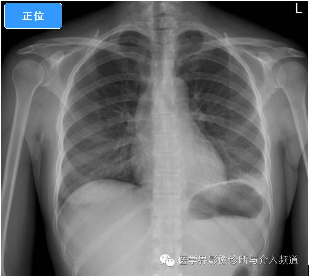 【病例】左肺下叶肺栓塞合并肺梗死1例CT影像表现 【病例】左肺下叶肺栓塞合并肺梗死1例CT影像表现