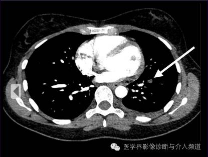 【病例】左肺下叶肺栓塞合并肺梗死1例CT影像表现 【病例】左肺下叶肺栓塞合并肺梗死1例CT影像表现