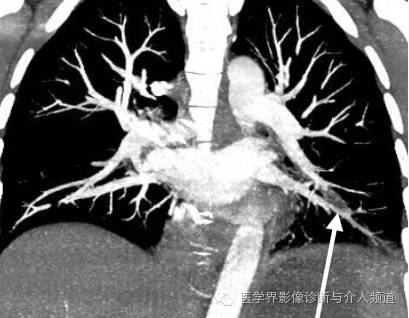 【病例】左肺下叶肺栓塞合并肺梗死1例CT影像表现 【病例】左肺下叶肺栓塞合并肺梗死1例CT影像表现
