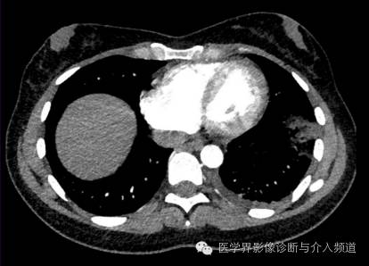 【病例】左肺下叶肺栓塞合并肺梗死1例CT影像表现 【病例】左肺下叶肺栓塞合并肺梗死1例CT影像表现