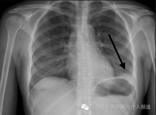 【病例】左肺下叶肺栓塞合并肺梗死1例CT影像表现 【病例】左肺下叶肺栓塞合并肺梗死1例CT影像表现