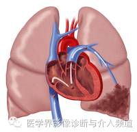 【病例】左肺下叶肺栓塞合并肺梗死1例CT影像表现 【病例】左肺下叶肺栓塞合并肺梗死1例CT影像表现