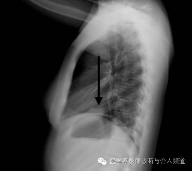 【病例】左肺下叶肺栓塞合并肺梗死1例CT影像表现 【病例】左肺下叶肺栓塞合并肺梗死1例CT影像表现