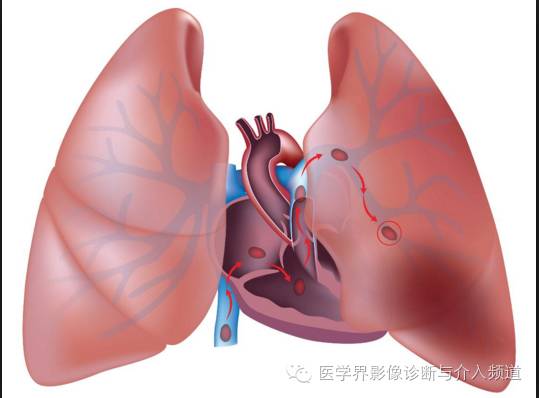 【病例】左肺下叶肺栓塞合并肺梗死1例CT影像表现 【病例】左肺下叶肺栓塞合并肺梗死1例CT影像表现
