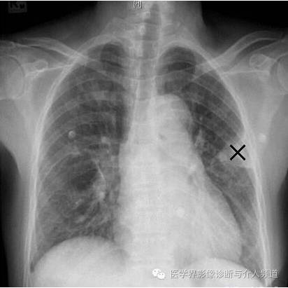 【病例】左肺下叶肺栓塞合并肺梗死1例CT影像表现 【病例】左肺下叶肺栓塞合并肺梗死1例CT影像表现