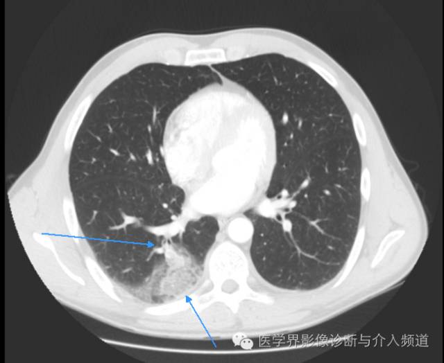 【病例】左肺下叶肺栓塞合并肺梗死1例CT影像表现 【病例】左肺下叶肺栓塞合并肺梗死1例CT影像表现