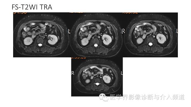 【病例】十二指肠间质瘤1例MR影像表现