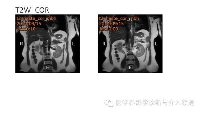 【病例】十二指肠间质瘤1例MR影像表现