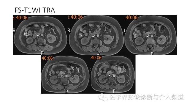 【病例】十二指肠间质瘤1例MR影像表现