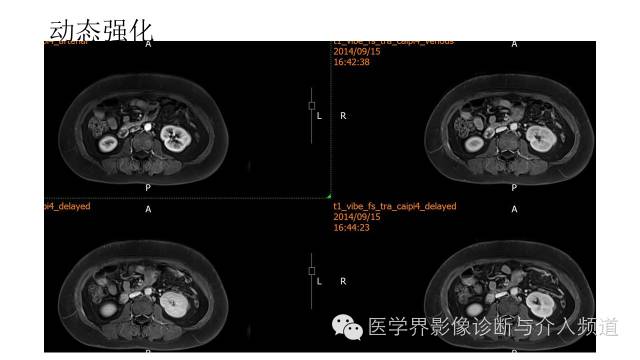 【病例】十二指肠间质瘤1例MR影像表现