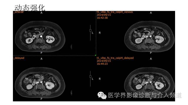 【病例】十二指肠间质瘤1例MR影像表现