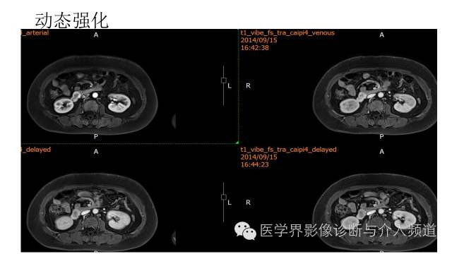 【病例】十二指肠间质瘤1例MR影像表现