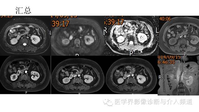 【病例】十二指肠间质瘤1例MR影像表现