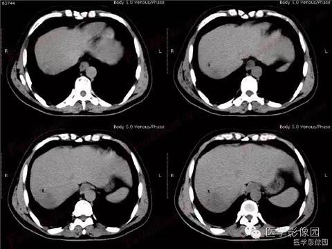 【病例】肝脓肿1例CT影像表现