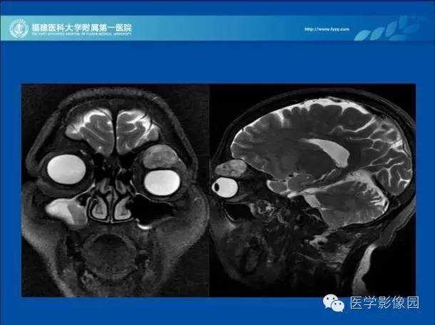【病例】眼眶病变MR检查技术及诊断