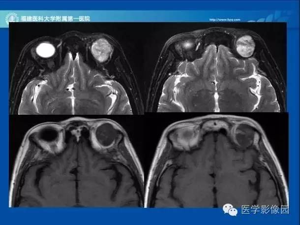 【病例】眼眶病变MR检查技术及诊断