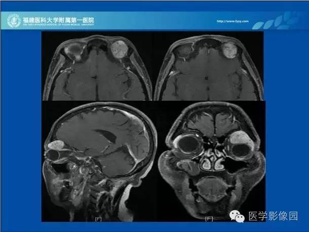 【病例】眼眶病变MR检查技术及诊断