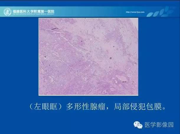 【病例】眼眶病变MR检查技术及诊断