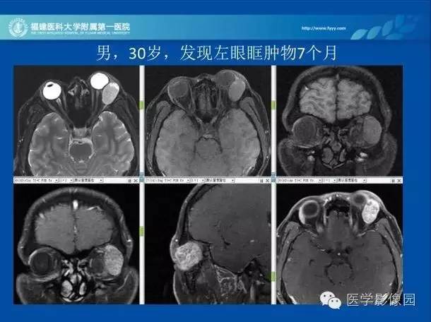 【病例】眼眶病变MR检查技术及诊断