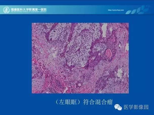 【病例】眼眶病变MR检查技术及诊断
