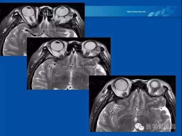 【病例】眼眶病变MR检查技术及诊断