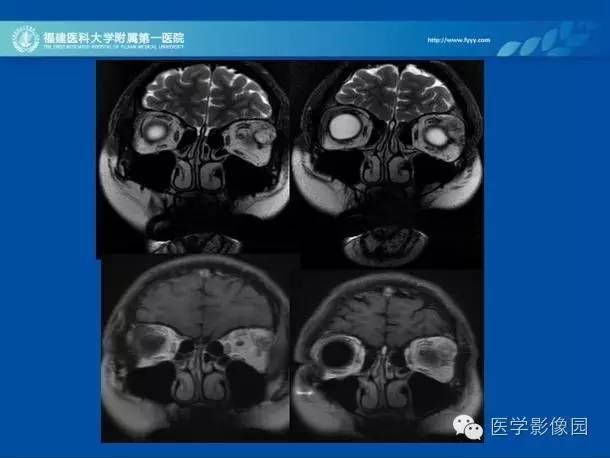 【病例】眼眶病变MR检查技术及诊断