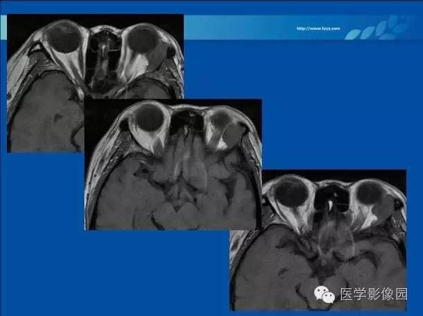 【病例】眼眶病变MR检查技术及诊断