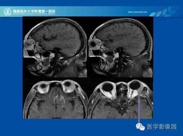 【病例】眼眶病变MR检查技术及诊断