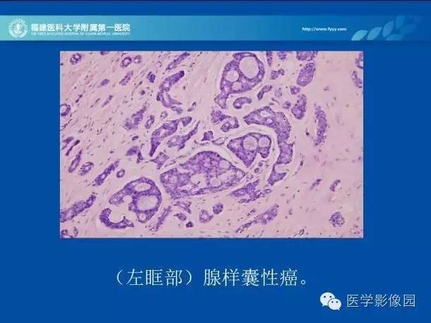 【病例】眼眶病变MR检查技术及诊断