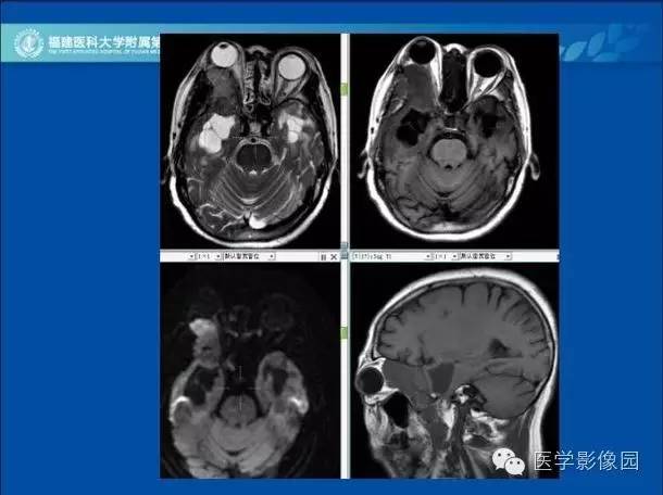 【病例】眼眶病变MR检查技术及诊断