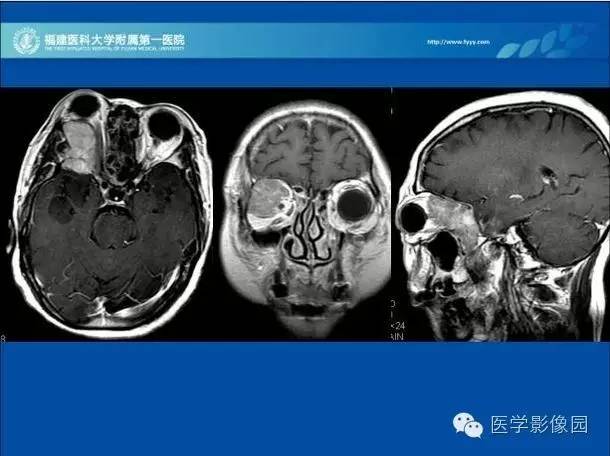 【病例】眼眶病变MR检查技术及诊断
