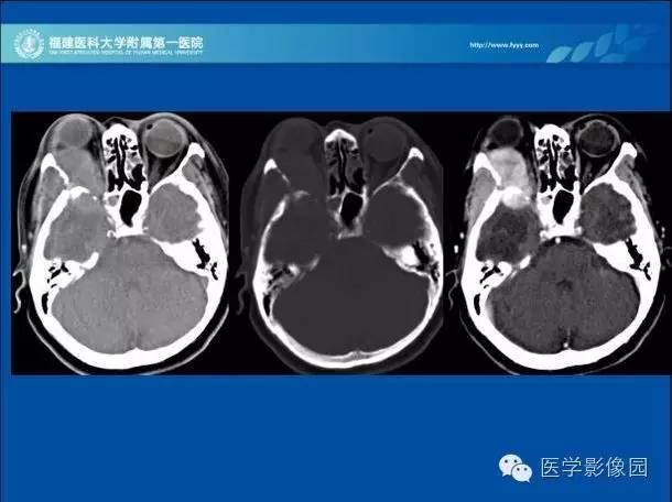 【病例】眼眶病变MR检查技术及诊断