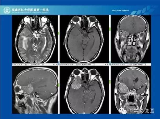 【病例】眼眶病变MR检查技术及诊断