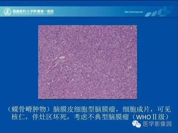 【病例】眼眶病变MR检查技术及诊断
