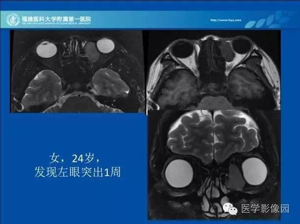 【病例】眼眶病变MR检查技术及诊断
