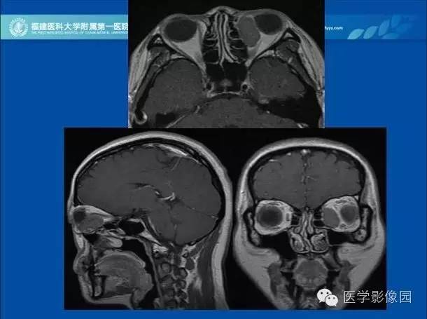 【病例】眼眶病变MR检查技术及诊断