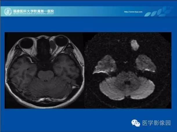 【病例】眼眶病变MR检查技术及诊断