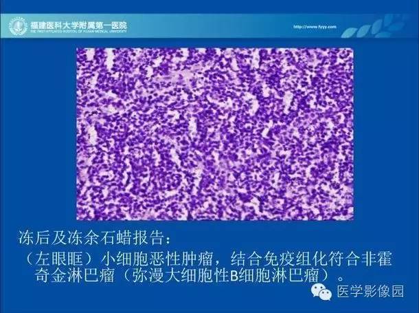 【病例】眼眶病变MR检查技术及诊断