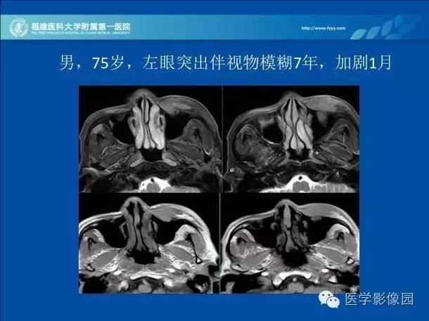 【病例】眼眶病变MR检查技术及诊断