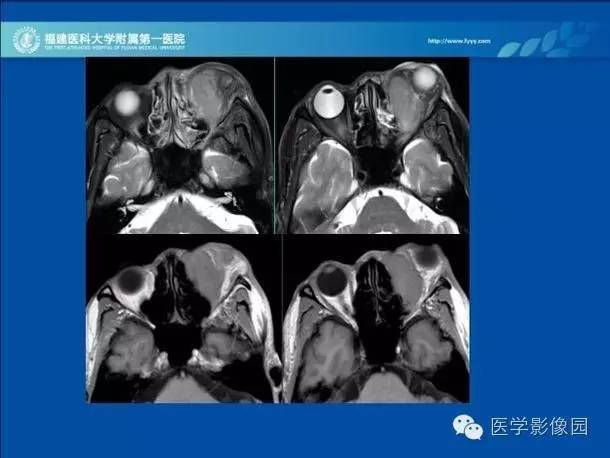 【病例】眼眶病变MR检查技术及诊断