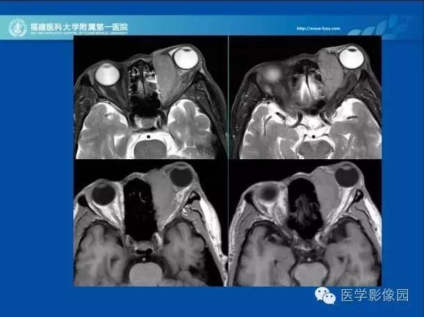 【病例】眼眶病变MR检查技术及诊断