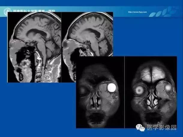 【病例】眼眶病变MR检查技术及诊断