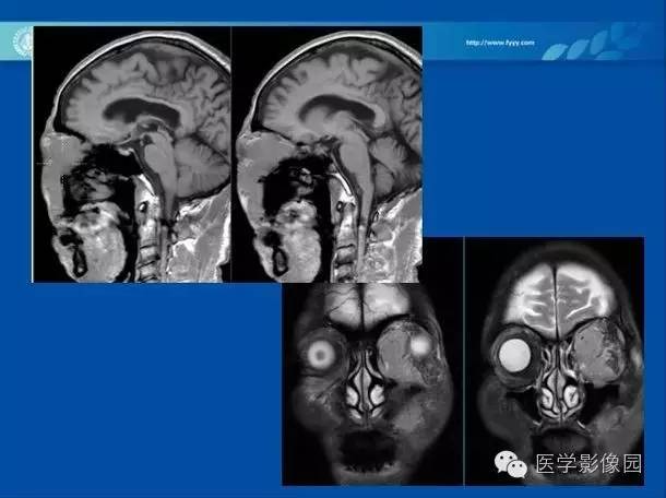 【病例】眼眶病变MR检查技术及诊断