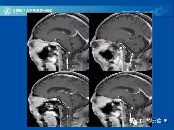 【病例】眼眶病变MR检查技术及诊断