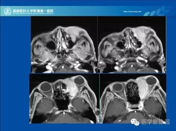 【病例】眼眶病变MR检查技术及诊断